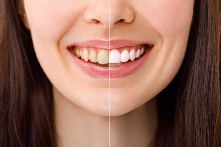 Is the teeth whitening kit approved by dentists?